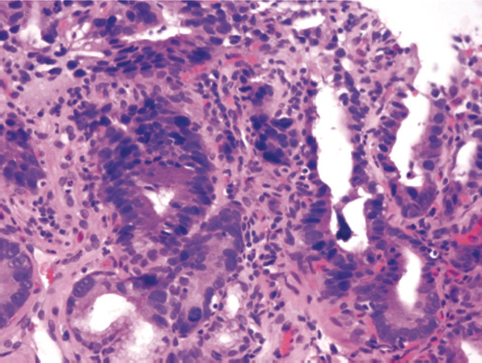 96: Endoscopic Mucosal Biopsy | Abdominal Key