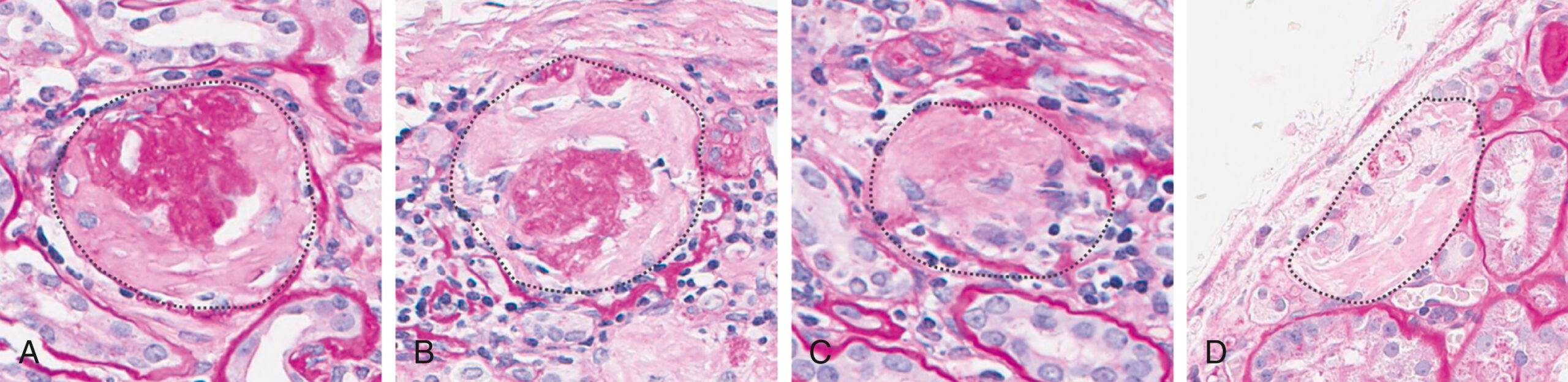 Four microscopic views of kidney glomeruli labeled A, B, C, and D, show varying degrees of structural changes. The first microscopic view, A, shows a glomerulus with dense dark staining. The second view B shows a glomerulus with less dense staining and some surrounding cellular infiltration. The third view C shows a glomerulus with further reduced staining density and more pronounced cellular infiltration. The fourth view D shows a glomerulus with significant structural disruption and extensive cellular infiltration.