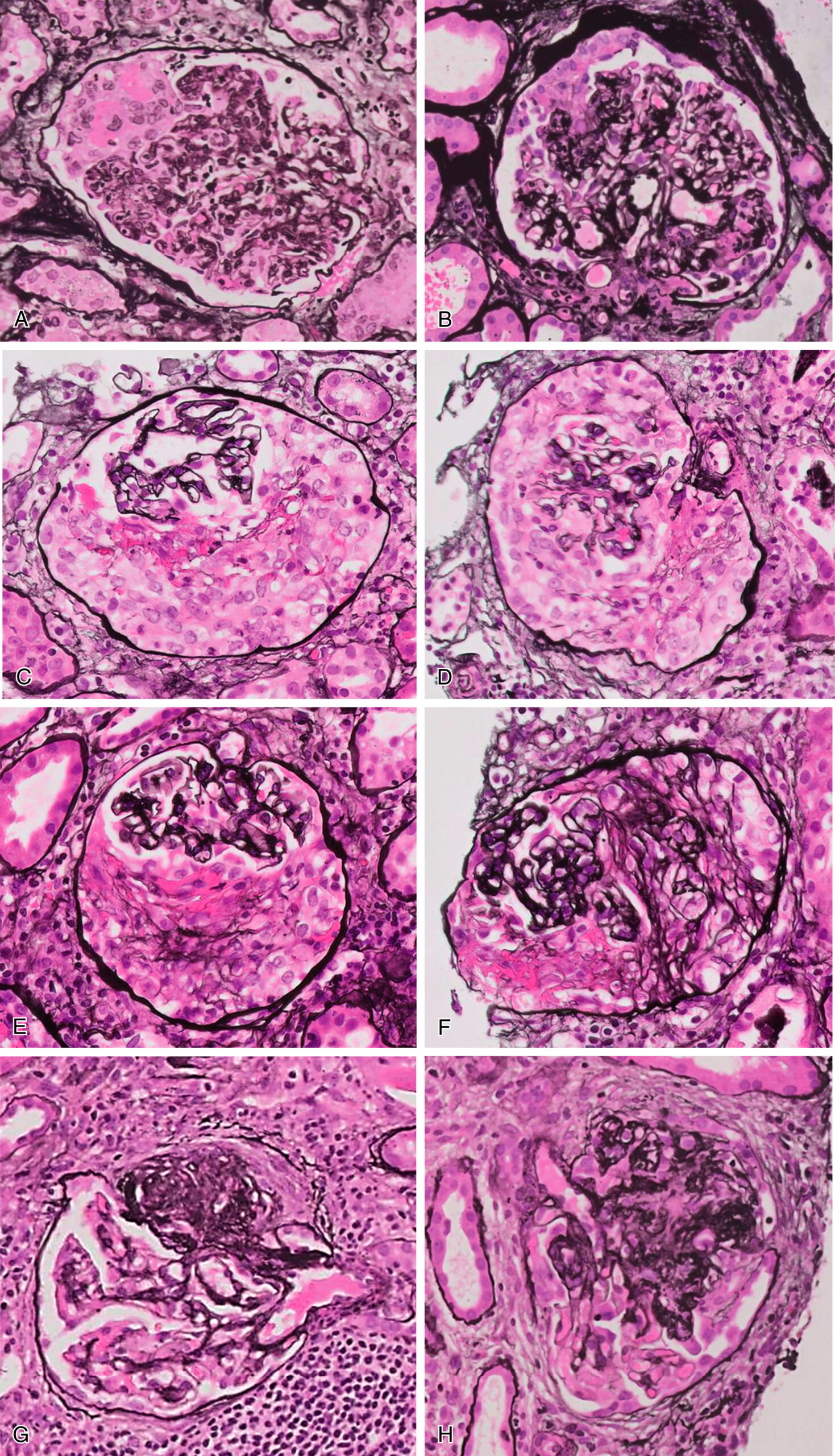 An eight-part microscopic photograph, labeled A through H, shows the stages of crescent formation in glomerulonephritis. Part A shows a segmental cellular crescent with fibrinoid necrosis, indicating early-stage injury. Part B presents a cellular crescent with contributions from visceral and parietal epithelial cells. Part C depicts an almost circumferential cellular crescent with streaks of fibrin. Part D shows a circumferential cellular crescent where early collagen fibers begin to appear. Part E highlights a fibrocellular crescent with both cellular and fibrotic components. Part F demonstrates the extension of collagen fibers, transitioning into a fibrous crescent. Part G reveals a segmental lesion likely resulting from crescent formation, resembling focal segmental glomerulosclerosis denoted as F S G S. Part H illustrates the final stage, where chronic lesions lead to an almost globally sclerotic glomerulus with extensive fibrosis and loss of normal structure.