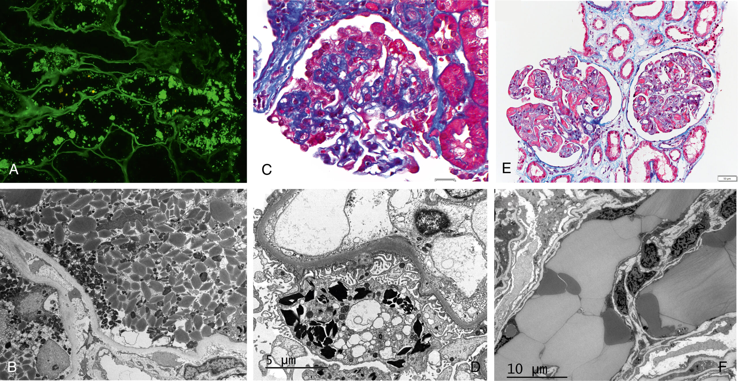 Six different microscope views illustrate the histological and immunofluorescence features of kidney glomeruli with different staining techniques. The six microscopic photos of the kidney tissue are labeled A to F using different staining methods. Section A is a green fluorescence photo showing protein distribution within the kidney. Section C shows a dense cellular pattern, and section D shows a trichrome-stained sample with a clearer glomerular structure and bright-field stained photographs on both sides. The electron microscopic images of sections B, D, and E show clear cellular details of the kidney structures, including capillary loops and the geometrically shaped crystals present in podocytes. That gives insight into the pathology at a microscopic level. Sections D and E are taken at 5 times and 10 times magnification, respectively.