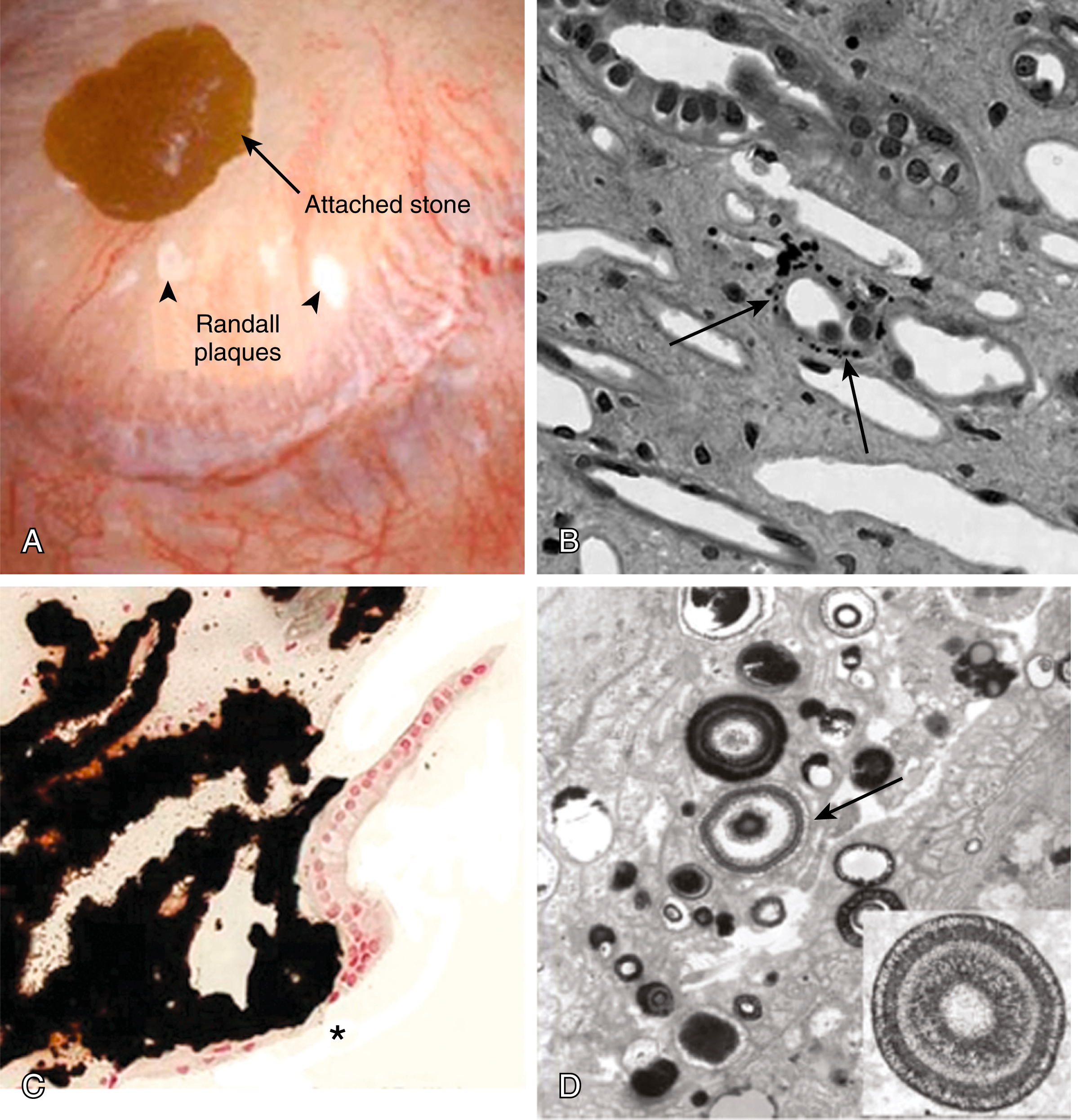 A four-part photograph depicts small plaque deposits in calcium oxalate kidney stones. The four-part photograph is labeled from A to D. Part A shows a kidney view through a scope with a small stone attached, marked by an arrow, and two plaque spots below, marked by arrowheads. Part B shows a close-up under a light microscope of tiny crystal deposits in the kidney’s thin loops, marked by arrows. Part C shows black-stained calcium phosphate deposits forming a larger lesion that reaches into the urine space, with an asterisk showing its size. Part D shows a detailed electron microscope view of individual deposits shaped like layered spheres, marked by an arrow.