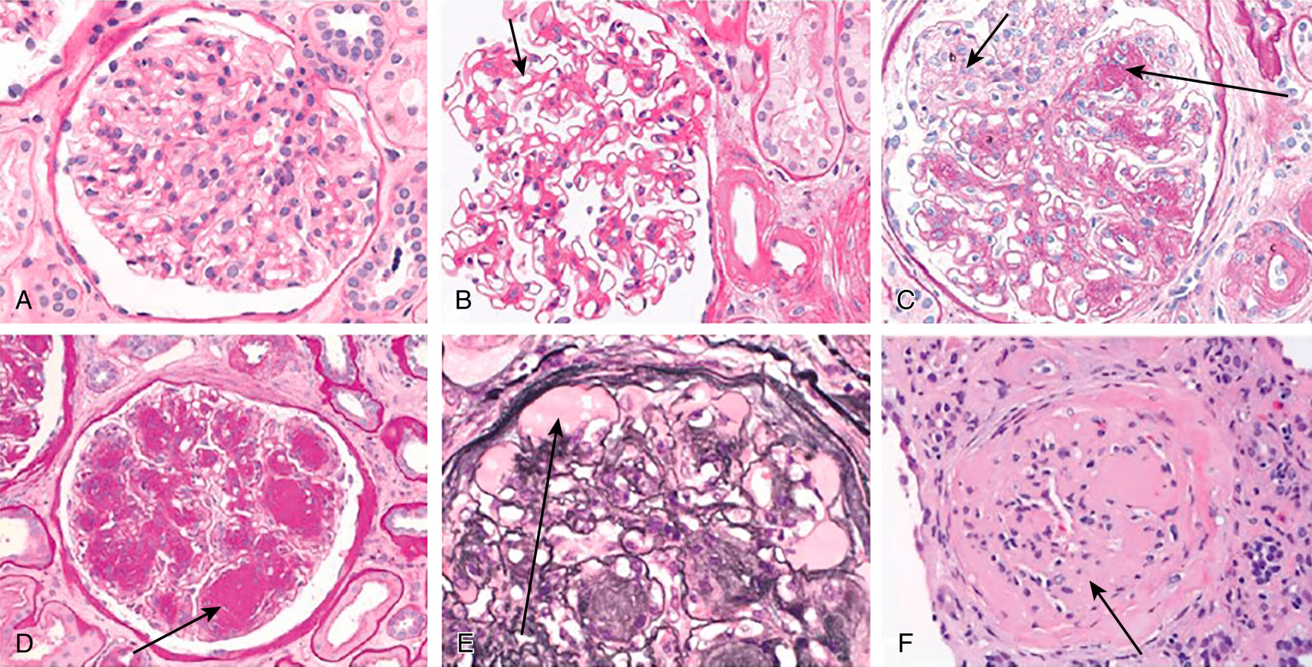 A six-part histology photograph, labeled A through F, depicts progressive glomerular changes in diabetic kidney disease. The photograph A depicts a normal glomerulus with well-defined capillary loops and mesangium. The photograph B highlights diffuse mesangial expansion with mesangial cell proliferation, with an arrow pointing to an expanded mesangial region. The photograph C presents prominent mesangial expansion with early nodularity and mesangiolysis, with arrows indicating affected areas. The photograph D illustrates the accumulation of mesangial matrix forming Kimmelstiel-Wilson nodules, characteristic of advanced diabetic nephropathy, with an arrow pointing to a nodule. The photograph E depicts dilation of capillaries forming microaneurysms with subintimal hyaline, plasmatic insudation, with an arrow marking a dilated capillary. Photograph F depicts an obsolescent glomerulus, with complete sclerosis and loss of normal structure, indicated by an arrow.