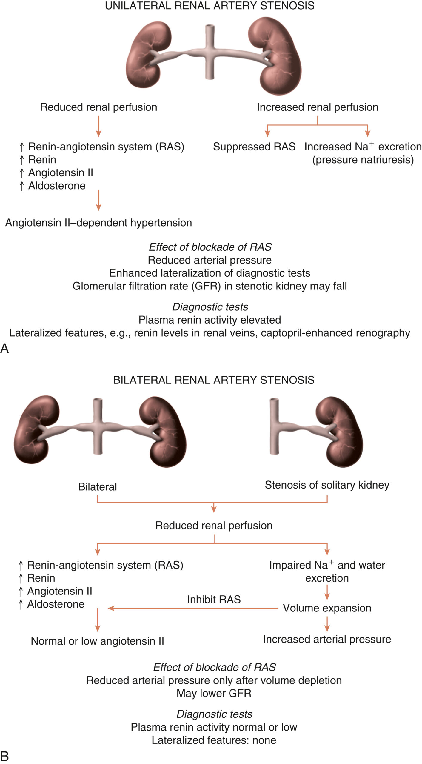 A two-part diagram shows the effects of unilateral and bilateral renal artery stenosis on renal function, with labeled structures and processes. The first part, labeled A, shows unilateral renal artery stenosis. The diagram first indicates reduced renal perfusion on the left kidney and another right kidney with increased renal perfusion on the right. Below, the sequence follows: Reduced renal perfusion triggers the renin angiotensin system, which leads to increased secretion of renin, angiotensin 2, and aldosterone. This results in Angiotensin 2-dependent hypertension due to reduced renal perfusion, and suppressed R A S causes increased sodium excretion or pressure natriuresis due to increased renal perfusion. The effect of R A S blockade is then displayed, showing enhanced lateralization of diagnostic tests and reduced arterial pressure. Below this, the diagram labels the diagnostic tests, such as glomerular filtration rate, and states that G F R in stenotic kidneys may fall, with plasma renin activity elevated. Lateralized features such as increased renin levels in renal veins and captopril-enhanced renography are also listed. The second part, labeled B, shows bilateral renal artery stenosis. The diagram shows the impact of bilateral stenosis: reduced renal perfusion is linked to impaired sodium and water excretion. Below this, the R A S is increased, renin, angiotensin 2, aldosterone, results in normal or low angiotensin 2. Impaired N a + and water excretion results in volume expansion, which raises arterial pressure. Volume expansion inhibits R A S and leads to normal or low angiotensin two. It also indicates that the effect of blockade of R A S leads to reduced arterial pressure only after volume depletion and may lower G F R. Diagnostic tests like plasma renin activity are normal or low and lateralized features are none.
