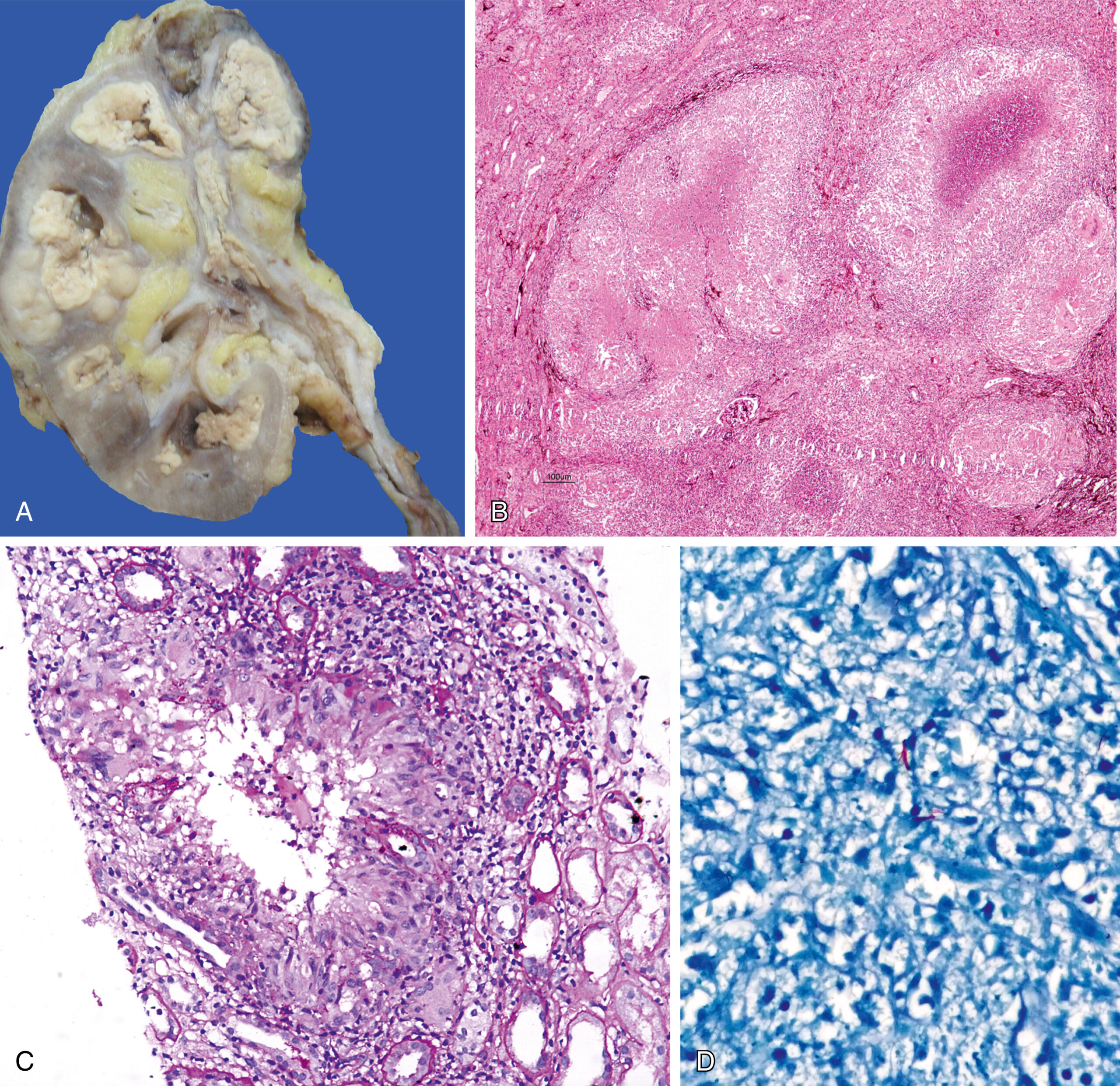 A photograph of a specimen of the kidney and three microscopic views of renal cells and tissues under different stains labeled A through D. The photograph and the three microscopic views are labeled A, B, C, and D, illustrating various pathological findings in the kidney. Panel A is a capture of a specimen of a kidney, showing extensive calcifications and areas, indicating chronic inflammation and tissue damage. The specimen surface reveals irregularities, including nodular lesions and dilated calyces with significant scarring and obstruction. Panel B is a microscopic view of the tissue cortex with pronounced fibrosis and glomerulosclerosis. The tubular structures are atrophied, and the interstitium is expanded with fibrotic tissue, reflecting advanced chronic kidney disease. Panel C shows numerous lymphocytes and plasma cells infiltrating the interstitial space. Tubular atrophy and the presence of proteinaceous casts within some tubules, and a few clear spaces appear on the upper right and lower left sections of the tissue. Panel D shows fibrotic tissue with dense fibrosis, few remaining functional structures scattered throughout the section in an irregular manner.