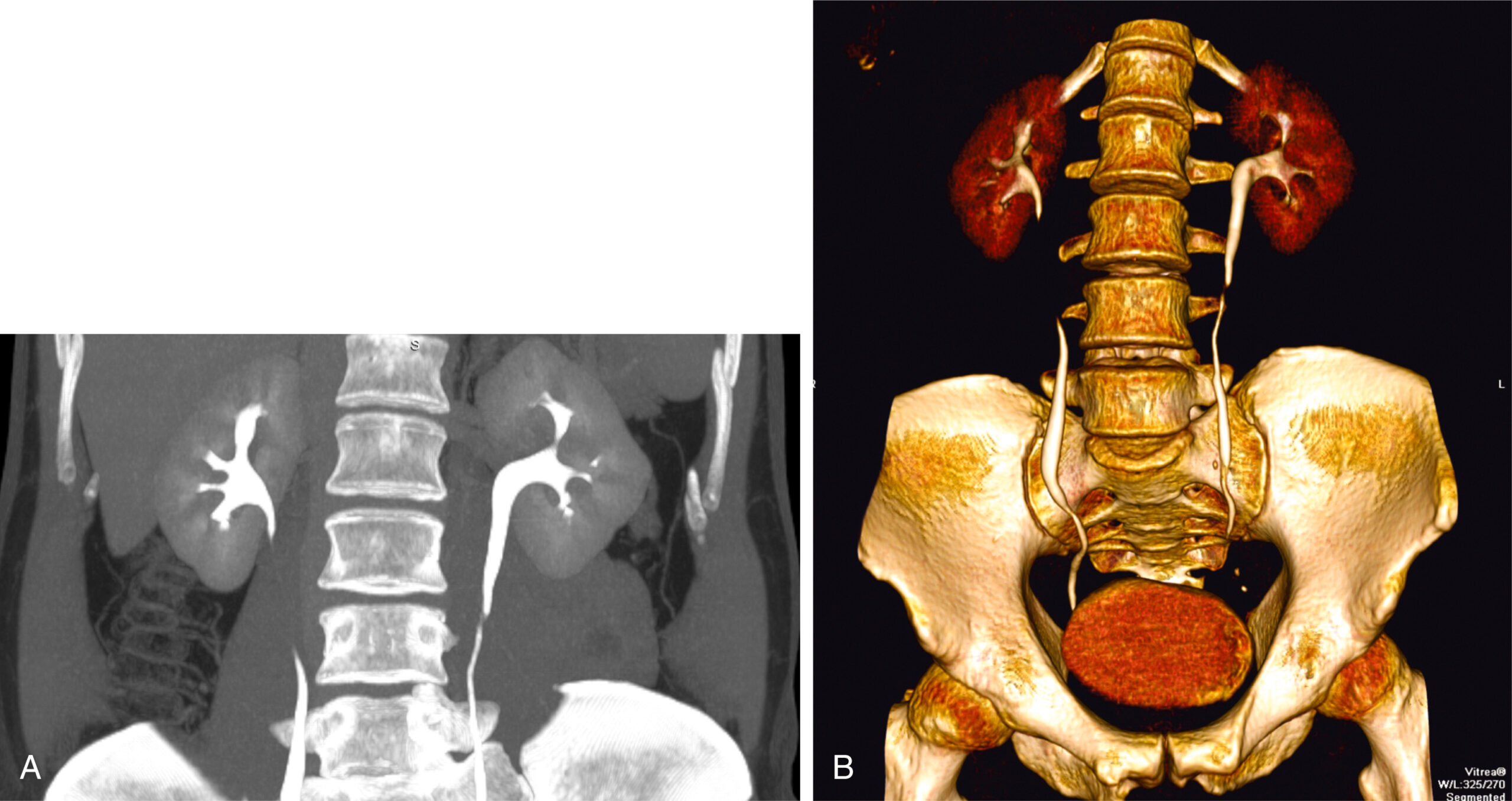 A two-part computed tomography, labeled A and B, depicts coronal maximum-intensity and volume-rendered views of the kidneys, ureters, bladder, and calyces. The first C T scan, labeled A, depicts a cross-section of the abdomen during the nephrographic phase, with both kidneys showing uniform enhancement. The kidney’s cortex and medulla are not separately visible. Surrounding abdominal organs and bowel loops are also seen. The second C T scan, labeled B, depicts a coronal section during the same phase, with both kidneys symmetrically enhanced and appearing uniform. The spine is visible in the center, with soft tissues on both sides.